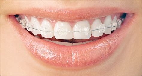 Fast Orthodontic Treatment How It Differs From Standard Braces Blog