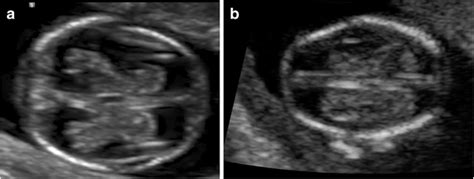 Axial View Of The Head In The First Trimester A Butterfly Shaped