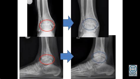 Ankle Distraction Surgery
