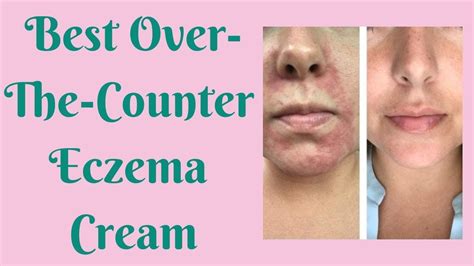 Best Over The Counter Eczema Cream Eczema Cream Eczema Skin Tags