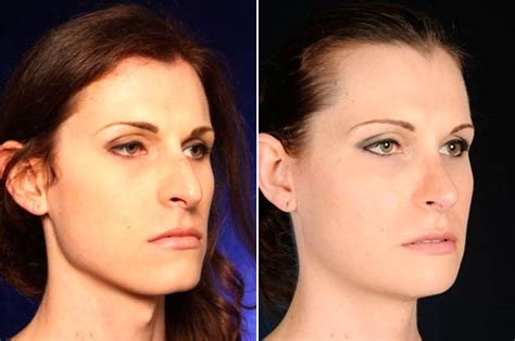 Facial Feminization Surgery Tracheal Shave Removing The Adams