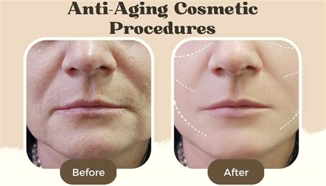 Top 4 Anti Aging Cosmetic Procedures For Women Over 50