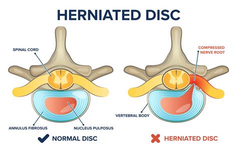 How To Heal A Herniated Disc Conway Medical Center