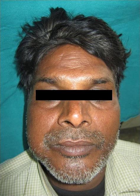 Clinical Picture Showing Diffuse Swelling Of The Right Side Of The Face