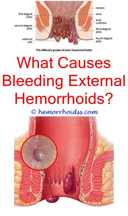 Pin On How To Treat Hemorrhoids