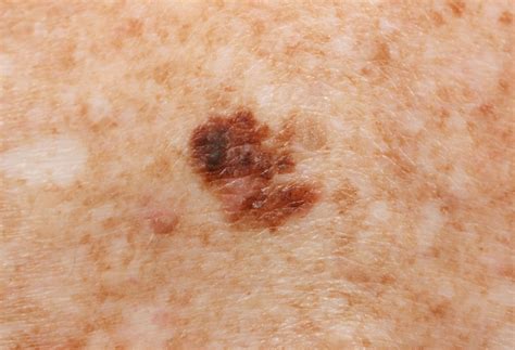 Melanoma Skin Cancer Stages