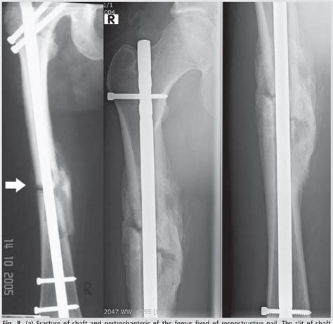 Pdf Assessment Of Femur Shaft Fractures Healing Treated By Closed