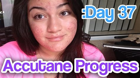 Day 37 Accutane Severe Acne Update I Like Pink Youtube