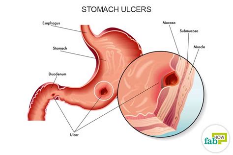 But i cannot tell an owner how long their pet will live because that decision, in the vast majority of cases i see, is up to them. How to Get Rid of Stomach Ulcers (Heal Fast with Home ...