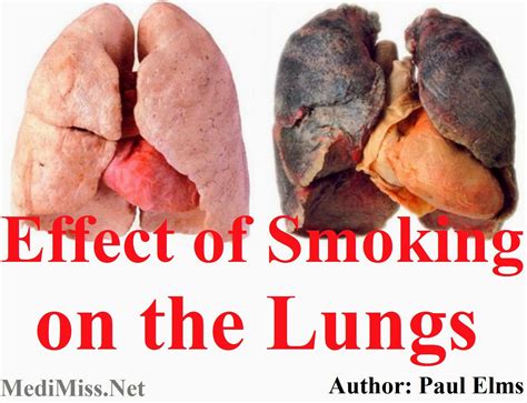 Effect Of Smoking On The Lungs Medimiss