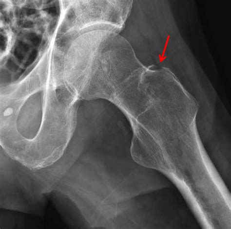 Fracture Du Trochanter Fracture Du Trochanter Personne âgée F88 F99