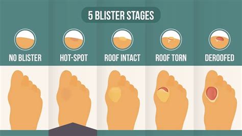 Hot Spot On Foot The 2nd Stage In The 5 Stage Blister Process Theory