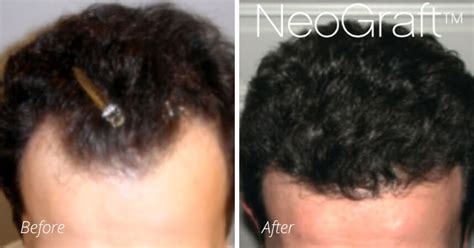 Before And After Gallery Denver Hair Restoration