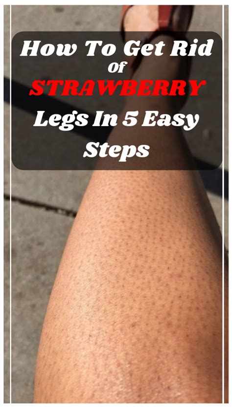 How To Get Rid Of Strawberry Legs In 5 Easy Steps Wellness Think 102