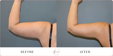 Arm Liposuction Before After