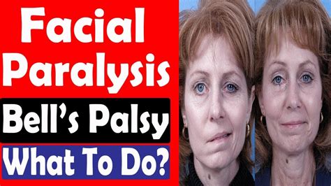 Facial Paralysis What To Do Bells Palsy Cure Facial Paralysis