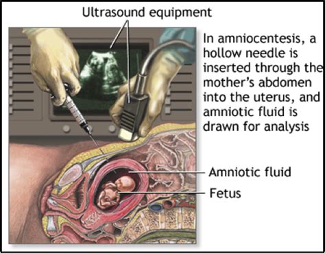 Amniocentesis Genetics Generation