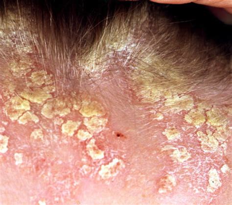 Itchy Sores On Scalp Pictures Photos