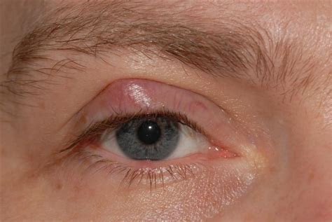 Sebaceous Cyst On Eyelid Cheap Factory Save 56 Jlcatjgobmx