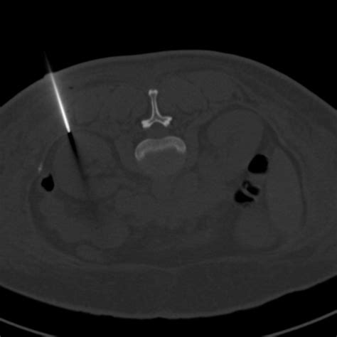 Ct Guided Renal Biopsy Image