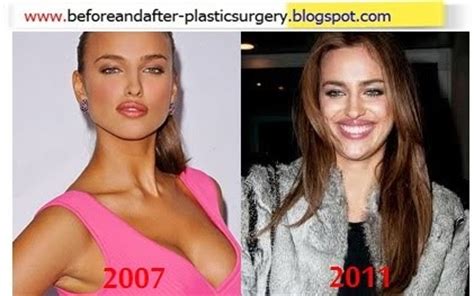 Irina shayk plastic surgery before and after photos. 