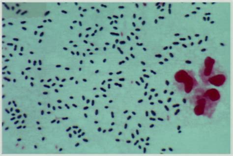 Cpp2 Gram Streptococcus Pneumoniae Pna And Meningitis Focus