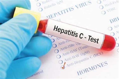 M Xico Ampl A Atenci N De Personas Con Hepatitis C Y Avanza En Eliminaci N Del Virus Almomento
