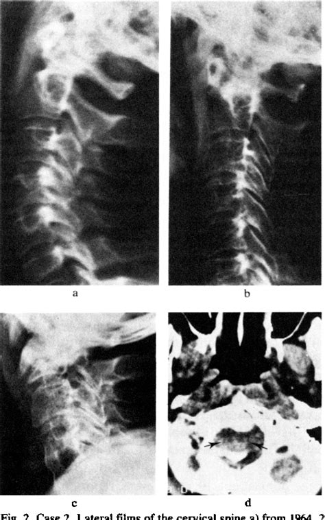Figure 2 From Atlanto Occipital Dislocation In Rheumatoid Arthritis