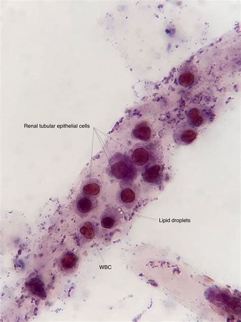 The cells are produced on a regular basis, and the old cells have to be shed, so as to give way to a new set of cells. Urine Sediment of the Month: Renal Tubular Epithelial ...