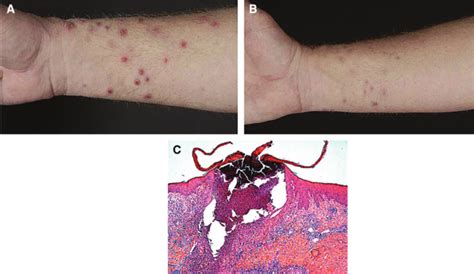 Patient 1 A Severe Purulent Perforating Bacterial Folliculitis With