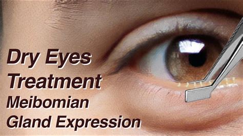 Dry Eyes Treatment With Meibomian Gland Expression Mgd Youtube
