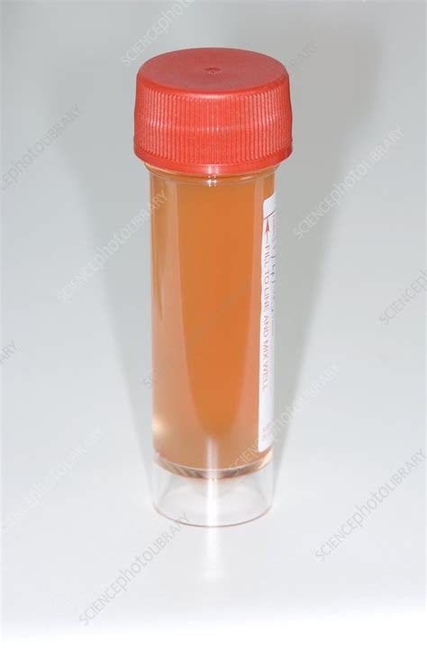 Blood In Urine In Bladder Cancer Stock Image C0041257 Science