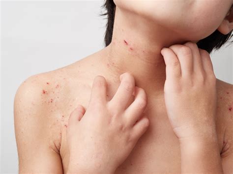 Dermatite Atopica Nei Bambini Foto Per Riconoscerla Nostrofiglio It