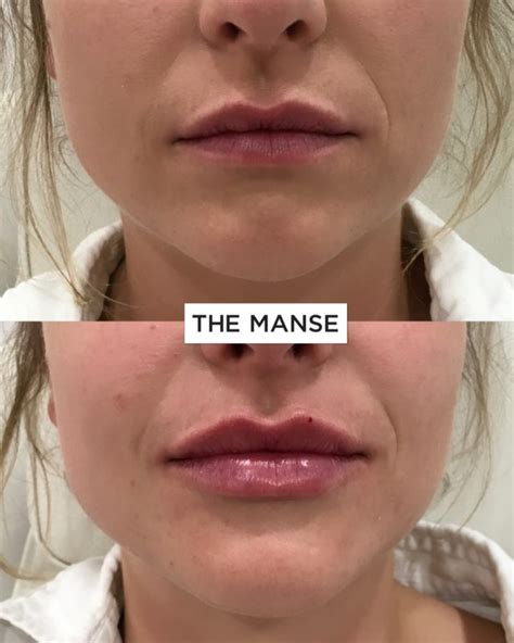 Lip Fillers Best Clinic Sydney For Dermal Fillers