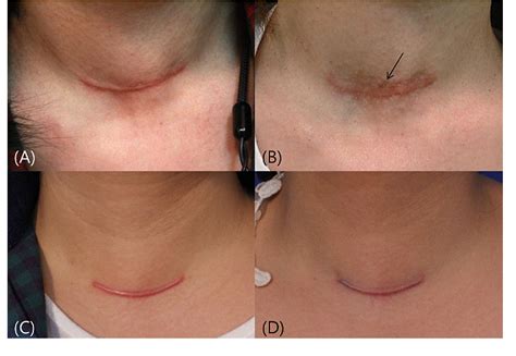 Evaluating Hypertrophic Thyroidectomy Scar Outcomes After Treatment