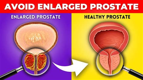Foods To Avoid An Enlarged Prostate Mens One News Page Video