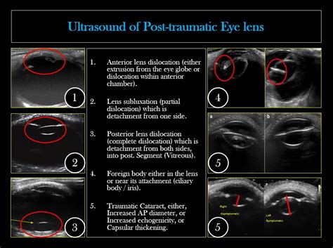 Pin On Ocular Ultrasound