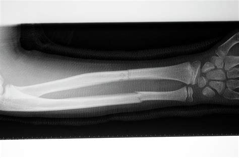 Broken Arm In A Cast Photograph By Dr P Marazziscience Photo Library