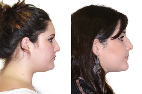 Face Asymmetry And Bite Correction Surgery Case Corrective Jaw