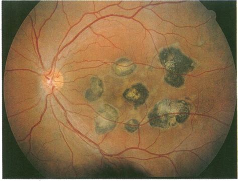 In diesem kapitel werden medizinische abkürzungen in alphabetischer form nur ganz kurz erklärt. Left acute posterior multifocal placoid pigment ...