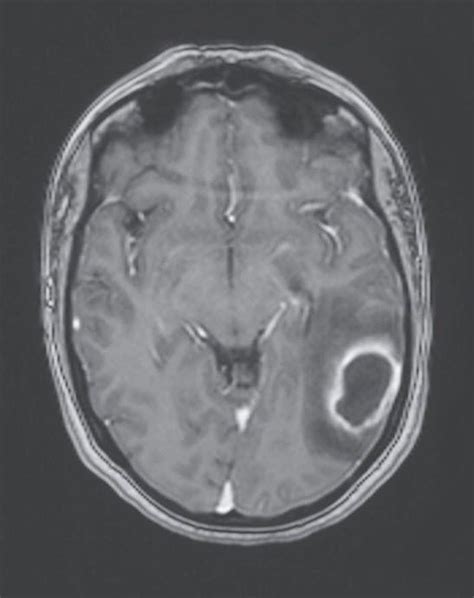 Brain Abscess Radiology Mri Brain Neurology