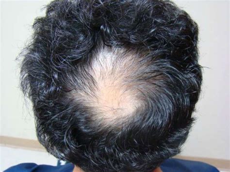 Everything You Need To Know About Male Hair Loss Hairstyles For