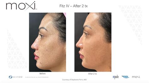 Patient 147776130 Sciton Moxi Laser Before And After Photos Austin