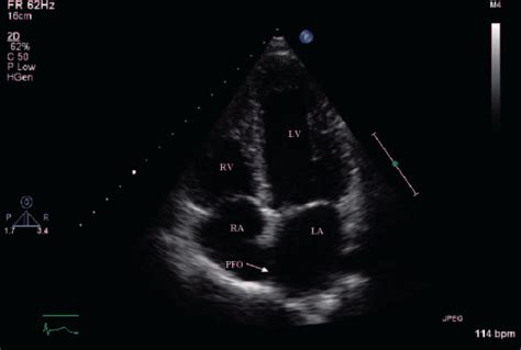 Transthoracic Echocardiogram Demonstrating The Patent Foramen Ovale