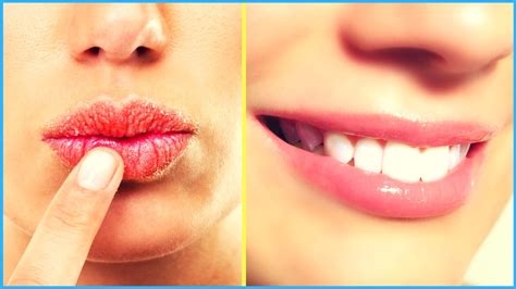 What Is A Good Treatment For Chapped Lips Lipstutorial Org