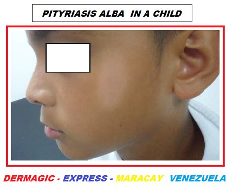 Learn about pityriasis alba including what pityriasis alba look like. DERMAGIC EXPRESS / Dermatologia y Bibliografia ...