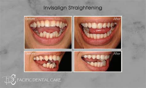 Invisalign Glendale Burbank Invisalign Pacific Dental Care