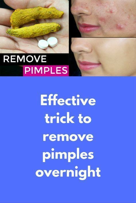 Acne As Well As Pimples Remedies Natural Means To Eliminate And Also