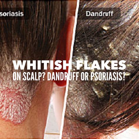 SoapLab Malaysia: Flaky White Thing On Your Hair: Is it Psoriasis Or ...