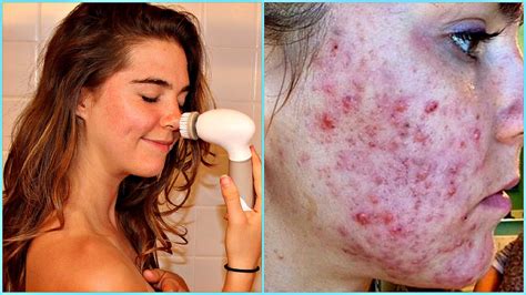 Remedios Caseros Para El Acne En La Cara Youtube